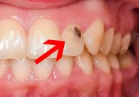 Featured image for Cavity Catastrophe: Your Guide to Preventing and Treating Tooth Decay