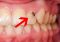 Featured image for Cavity Catastrophe: Your Guide to Preventing and Treating Tooth Decay