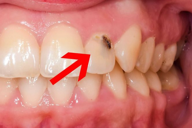 Featured image for Cavity Catastrophe: Your Guide to Preventing and Treating Tooth Decay