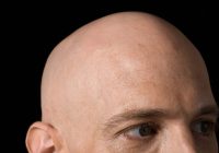 Featured image for Bald Spots and Beyond: Navigating Alopecia Areata Challenges