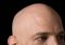 Featured image for Bald Spots and Beyond: Navigating Alopecia Areata Challenges