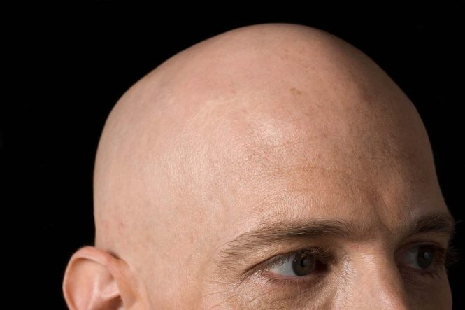 Featured image for Bald Spots and Beyond: Navigating Alopecia Areata Challenges