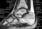Featured image for Ankle Sprains and Strains: Effective Recovery Strategies