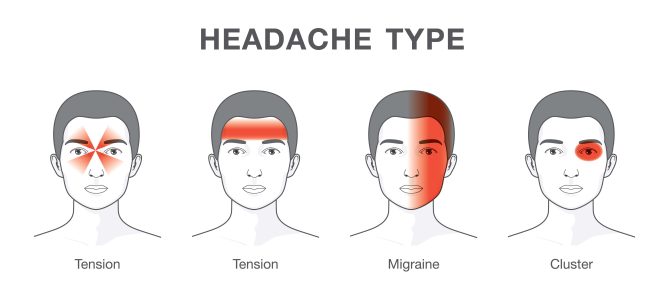 Featured image for Headaches from the Neck: How Physiotherapy Can Offer Relief