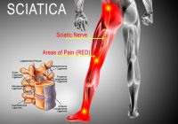 Featured image for Sciatica Explained: Easing Nerve Pain from Hips to Toes
