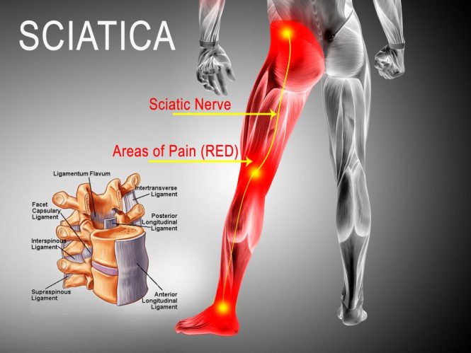 Featured image for Sciatica Explained: Easing Nerve Pain from Hips to Toes